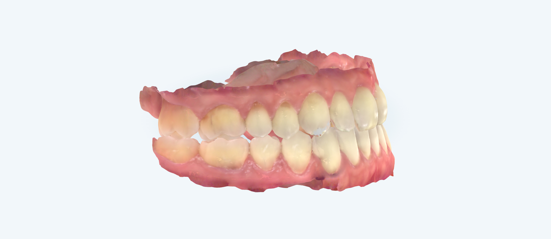 Underbite treatment comparison frontal bite view after